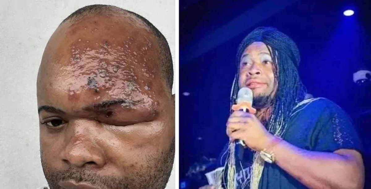 Nadamastor malade son oeil enflé